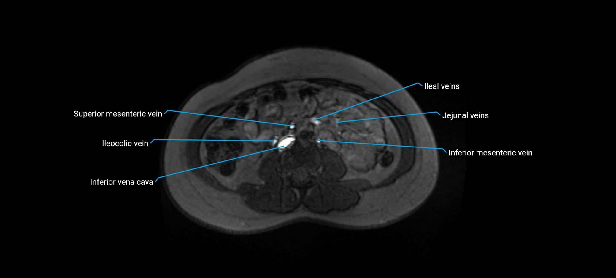 MRV abdomen pelvis & lower limb axial cross sectional anatomy labelled MRI image 99 (1).webp